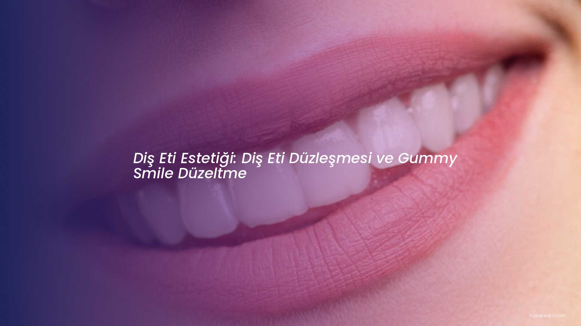 Diş Eti Estetiği: Diş Eti Düzleşmesi ve Gummy Smile Düzeltme Diş Eti Estetiği: Diş Eti Düzleşmesi ve Gummy Smile Düzeltme