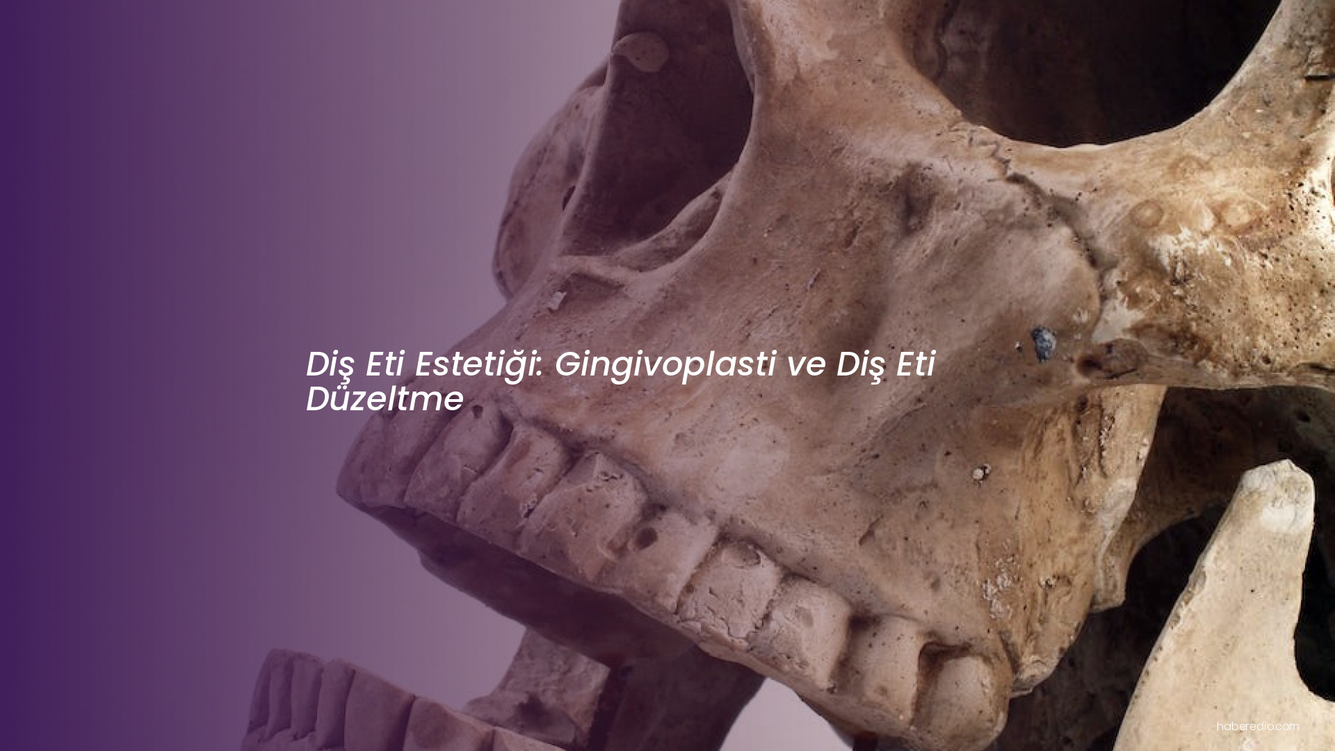 Diş Eti Estetiği: Gingivoplasti ve Diş Eti Düzeltme Diş Eti Estetiği: Gingivoplasti ve Diş Eti Düzeltme